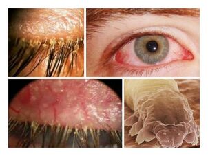 symptômes de parasites sous la peau humaine